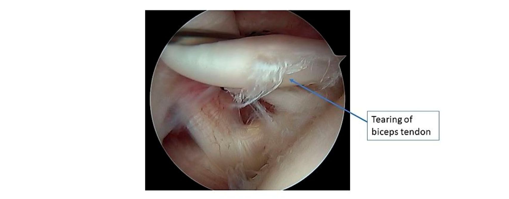 arthroscopic-image-inside-the-shoulder-joint.jpg