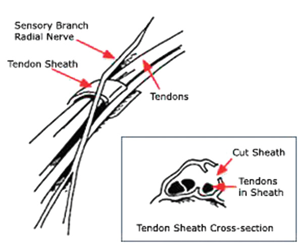 deQuervain's-Tendinitis_Page_3_Image_0001