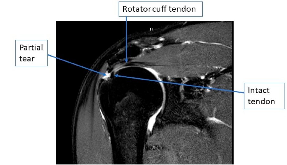 Shoulder Treatment in Muskegon & Grand Haven, MI | Orthopaedic ...